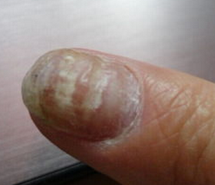 �ֻ�ָ�׳���֢״