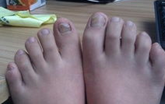 ��ֺ�׻�ָ��֢״