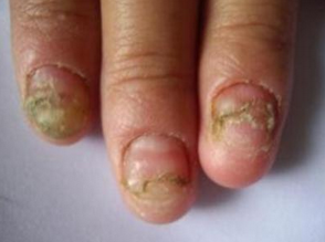 灰指甲有几种症状 灰指甲有几种症状