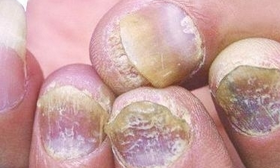 ��ָ�׵ĳ���֢״����