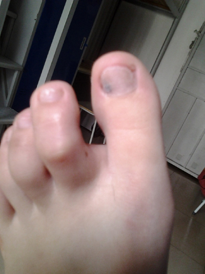 ��ָ�׵������֢״����Щ