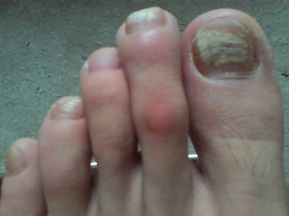 脚灰指甲初期症状 脚灰指甲初期症状