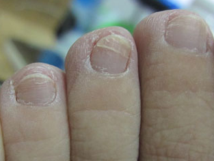 灰指甲开始症状 灰指甲开始症状