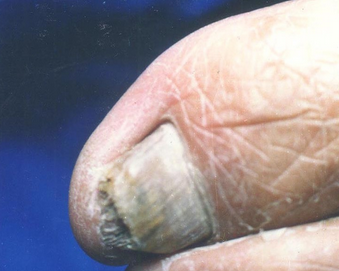 ��ָ��ǰ��֢״����Щ