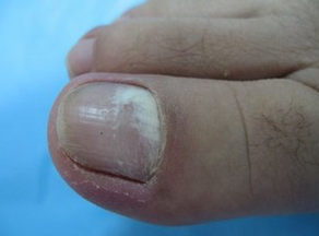 灰指甲患者症状表现 灰指甲患者症状表现