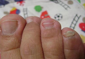 灰指甲还会引起哪些症状 灰指甲还会引起哪些症状