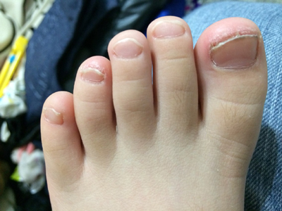 小孩灰指甲的初期症状 小孩灰指甲的初期症状