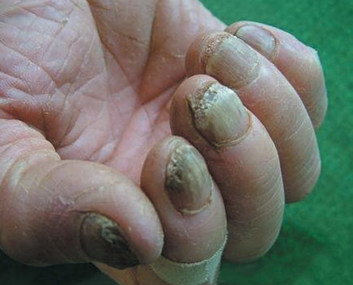 灰指甲的临床症症状 灰指甲的临床症症状