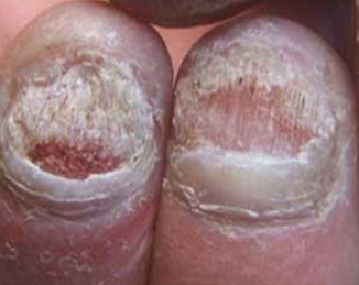 灰指甲的严重症状 灰指甲的严重症状