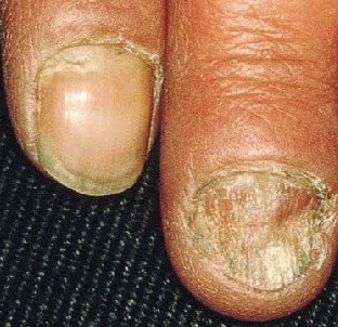 ��ָ�׳�ʼ֢״