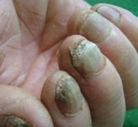 灰指甲感染初期症状治疗 灰指甲感染初期症状治疗