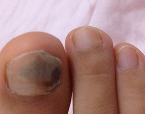 灰指甲症状初期症状 灰指甲症状初期症状