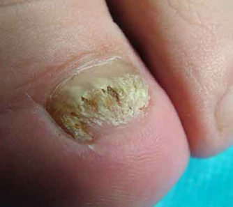 灰指甲初期的症状有哪些 灰指甲初期的症状有哪些