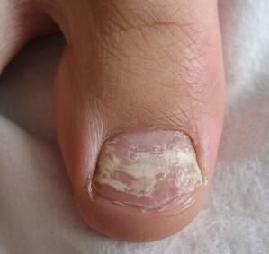 常见灰指甲的症状 常见灰指甲的症状