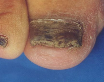 灰指甲症状是什么样的 灰指甲症状是什么样的