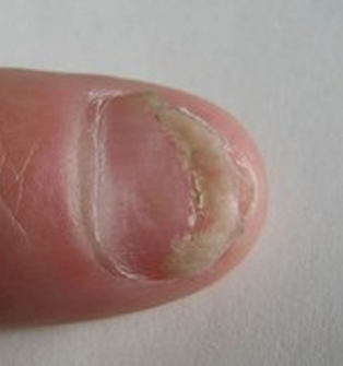 灰指甲的症状是怎样的 灰指甲的症状是怎样的