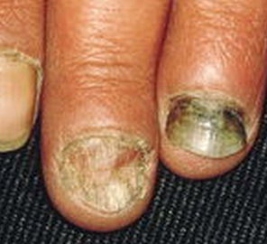 灰指甲的症状都有哪些 灰指甲的症状都有哪些