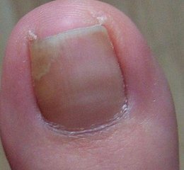 灰指甲的常见症状
