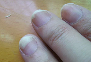 ��ָ�׵�֢״������