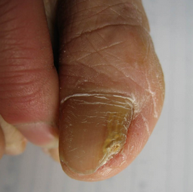 灰指甲的发病症状有哪些 灰指甲的发病症状有哪些