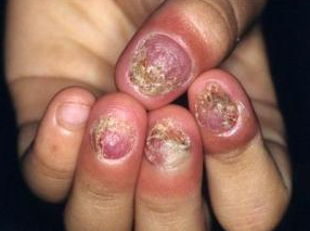灰指甲的症状和治疗 灰指甲的症状和治疗