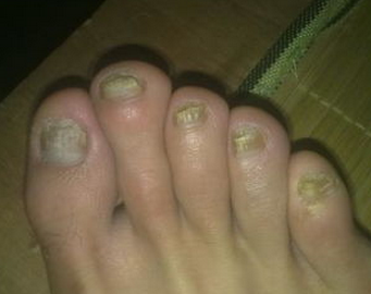 灰指甲的症状和原因 灰指甲的症状和原因