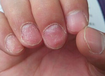 ��ָ��ָ�׵ĳ���֢״