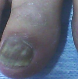 灰指甲的初期症状如何 灰指甲的初期症状如何