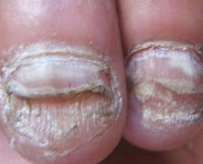 手指灰指甲的症状 手指灰指甲的症状