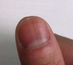 ��ָ�׵ĳ���֢״ʲô��