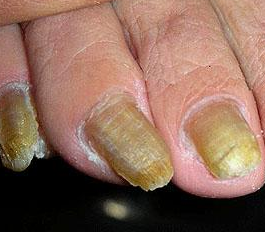 ������ָ�׵�֢״����Щ