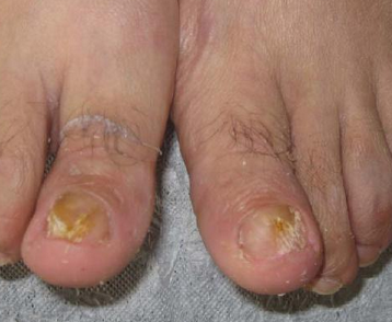 轻微灰指甲的症状 轻微灰指甲的症状