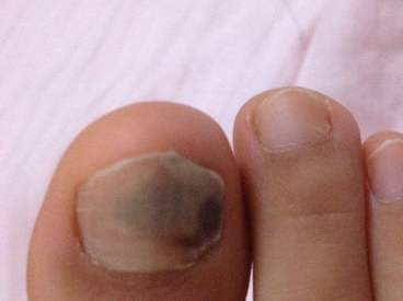 灰指甲的症状疼不疼 灰指甲的症状疼不疼