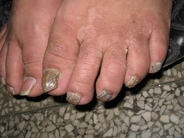 灰指甲最初的症状表现 灰指甲最初的症状表现