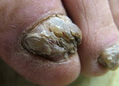 灰指甲表现症状 灰指甲表现症状