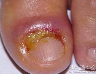 甲沟炎会不会引起破伤风呀