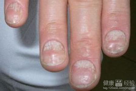 我手大母指有点甲沟炎,要怎么办