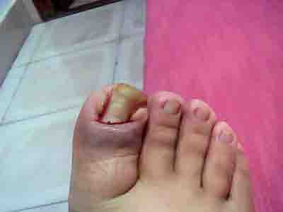 修脚能治甲沟炎 修脚能治甲沟炎