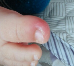 Ӥ�����׹�����ʲôҩ