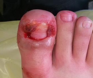 中医治疗<a href=/hzj/ target=_blank class=infotextkey><a href=/hzj/ target=_blank class=infotextkey>灰指甲</a></a>的偏方 中医治疗灰指甲的偏方