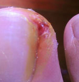 治疗甲沟炎症方式方法 治疗甲沟炎症方式方法