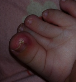 治甲沟炎偏方 治甲沟炎偏方