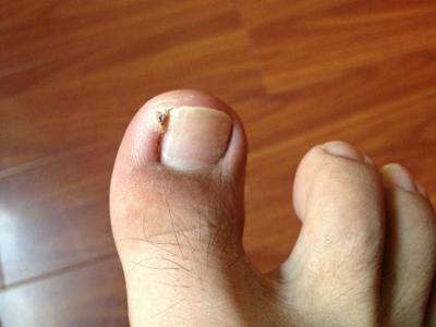 有什么方法治疗甲沟炎 有什么方法治疗甲沟炎