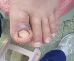 怎么样根治甲沟炎 怎么样根治甲沟炎