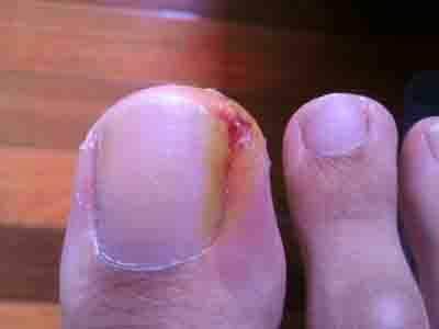 怎样根治甲沟炎 怎样根治甲沟炎