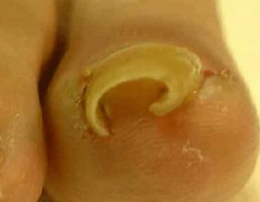 治甲沟炎的药 治甲沟炎的药