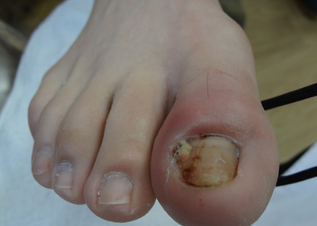 修脚店怎么治甲沟炎 修脚店怎么治甲沟炎