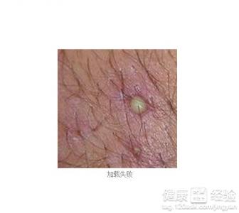 �ز�������ҽ��˵��ë���׸���ô��
