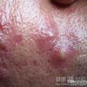 得了糠秕袍子菌毛囊炎该怎么办