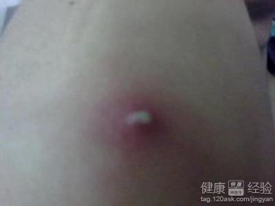 毛囊炎和脂溢性皮炎该怎么治疗